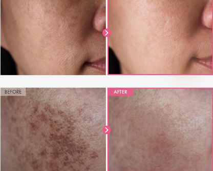 Arbutin 7% + Tranexamic 4% Brightening Cream